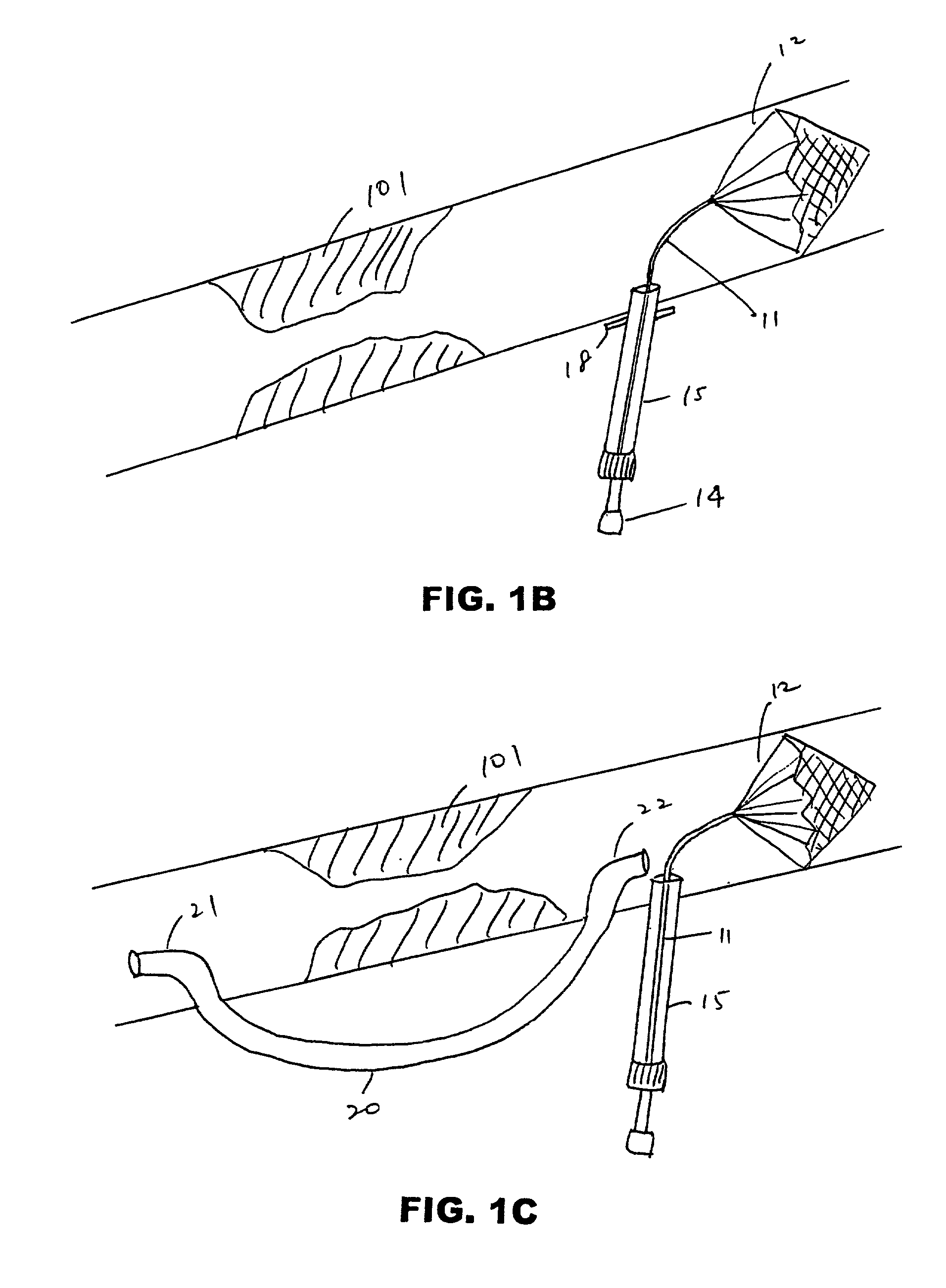 Cerebral protection during carotid endarterectomy and methods of use