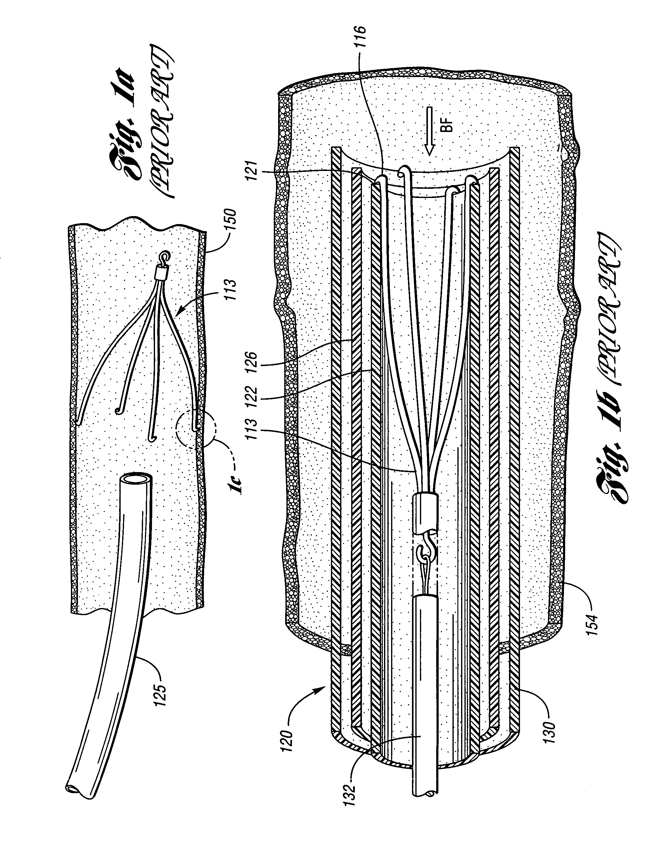 Removable vena cava filter having inwardly positioned anchoring hooks in collapsed configuration