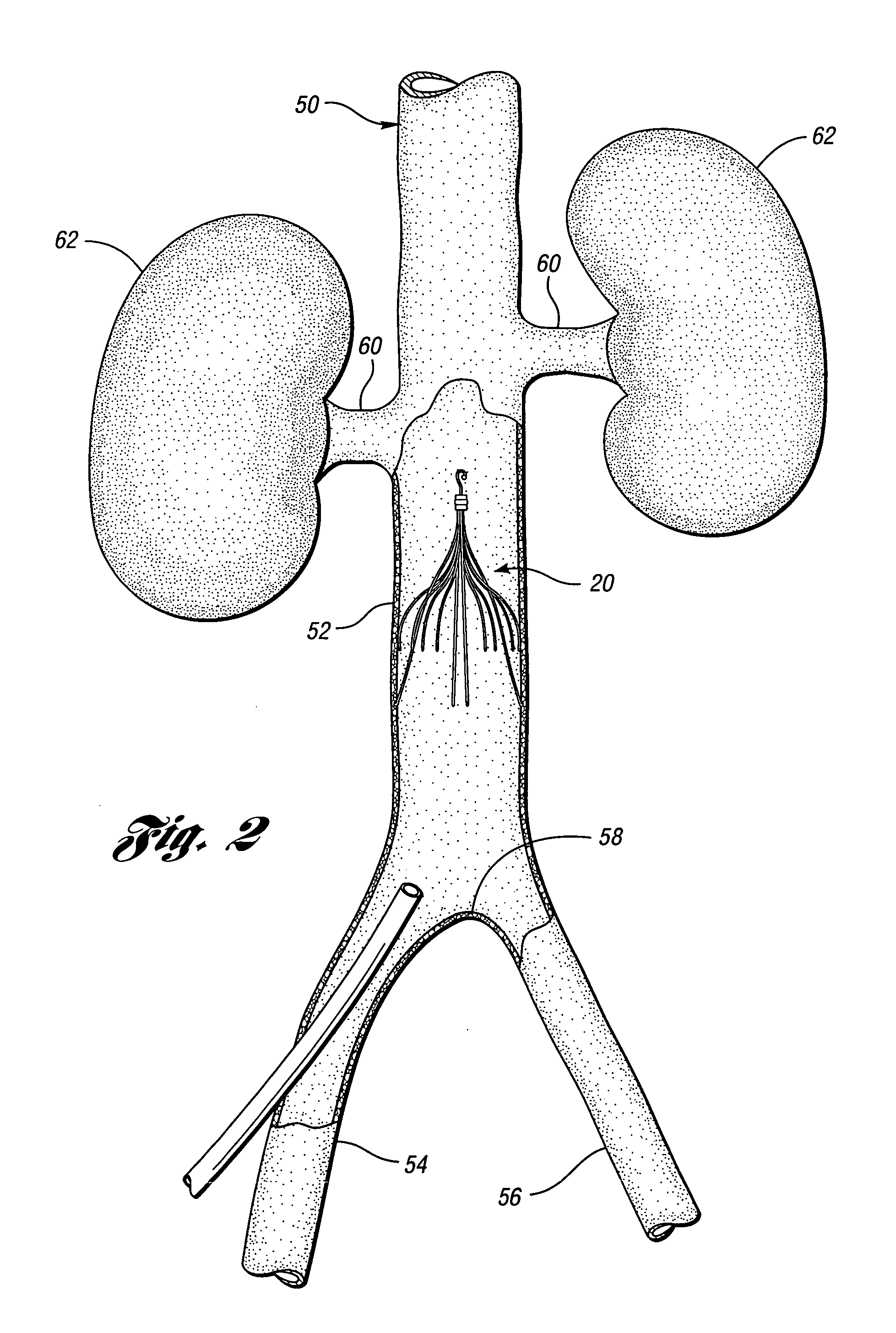 Removable vena cava filter having inwardly positioned anchoring hooks in collapsed configuration