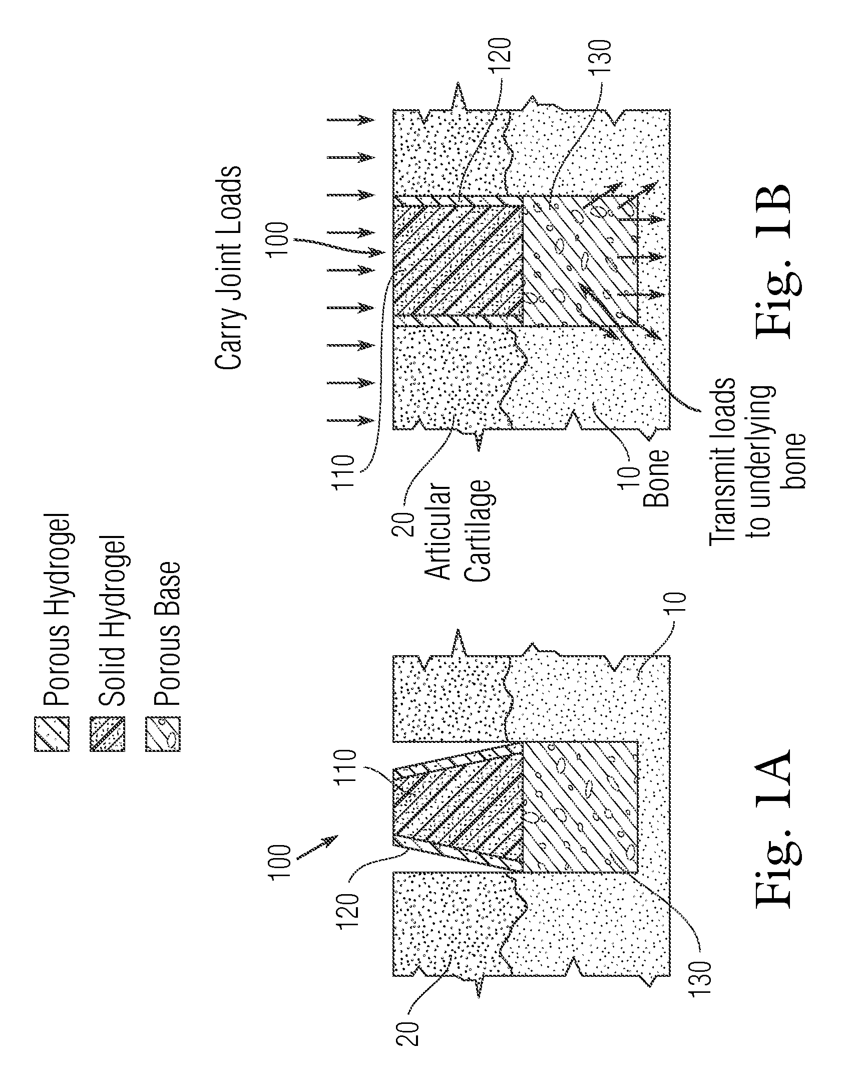 Multi-component non-biodegradable implant, a method of making and a method of implantation
