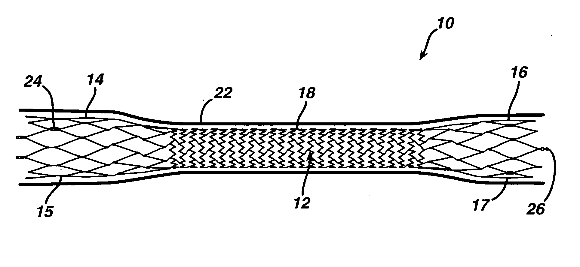 Prosthesis comprising dual tapered stent