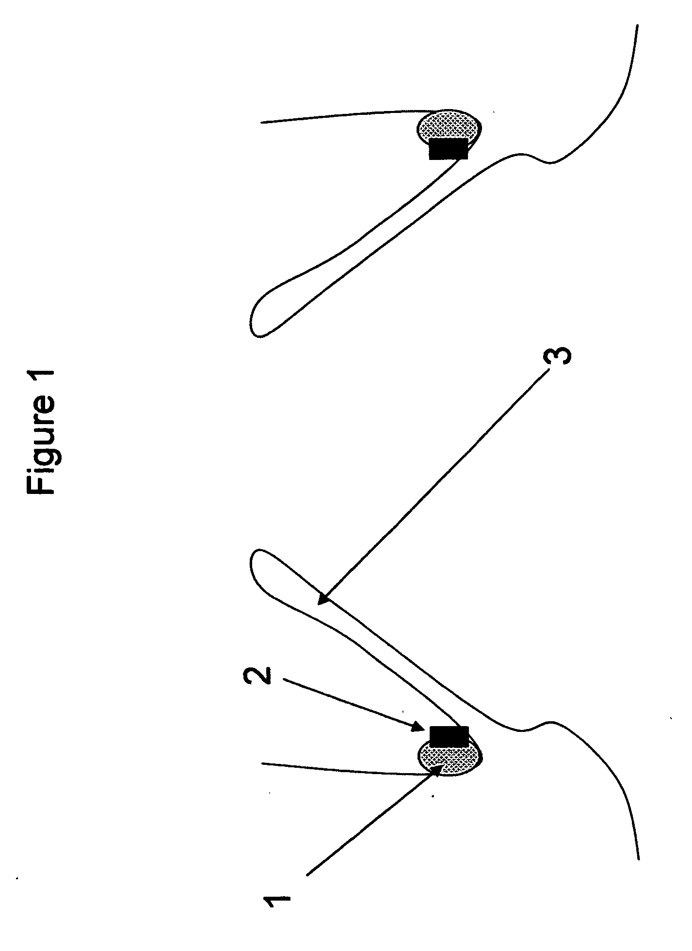 Method and apparatus for anchoring implants