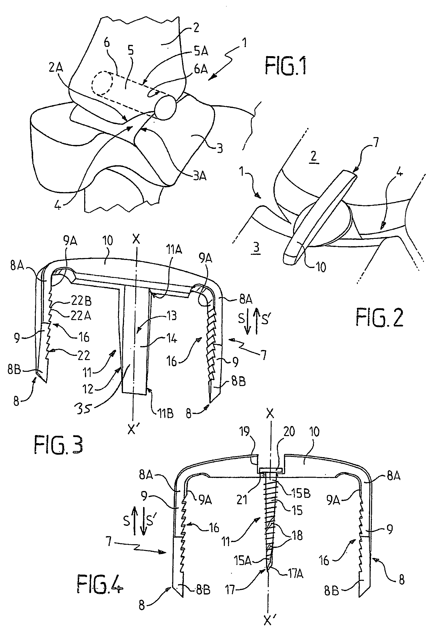 Fixation implant for a bone graft within a joint for the purpose of ensuring arthrodesis of the joint