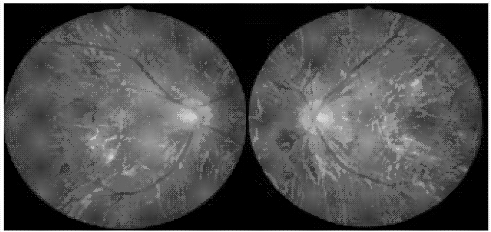 CYP4V2 gene mutant and application thereof