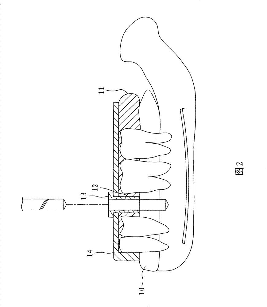 Method for manufacturing dental implantation surgical guide plate