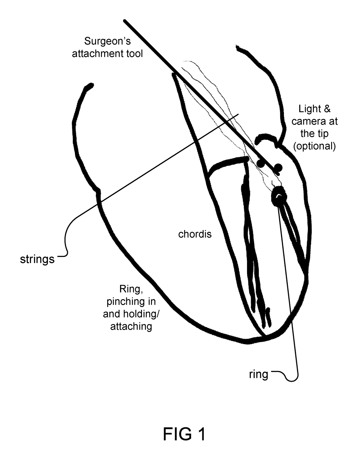 Heart surgery apparatus