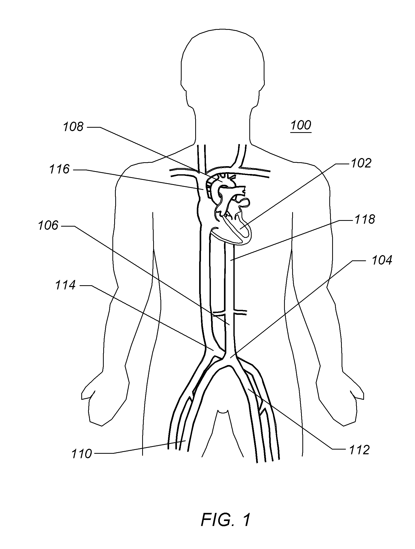 Expandable iliac sheath and method of use