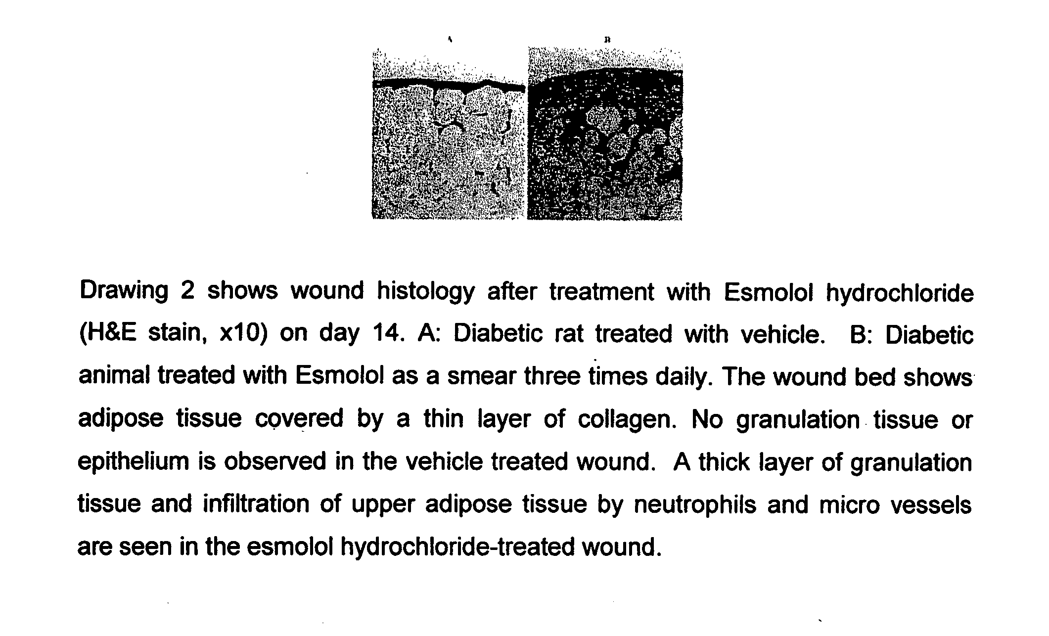 Pharmaceutical Composition for Treatment of Diabetic Complications