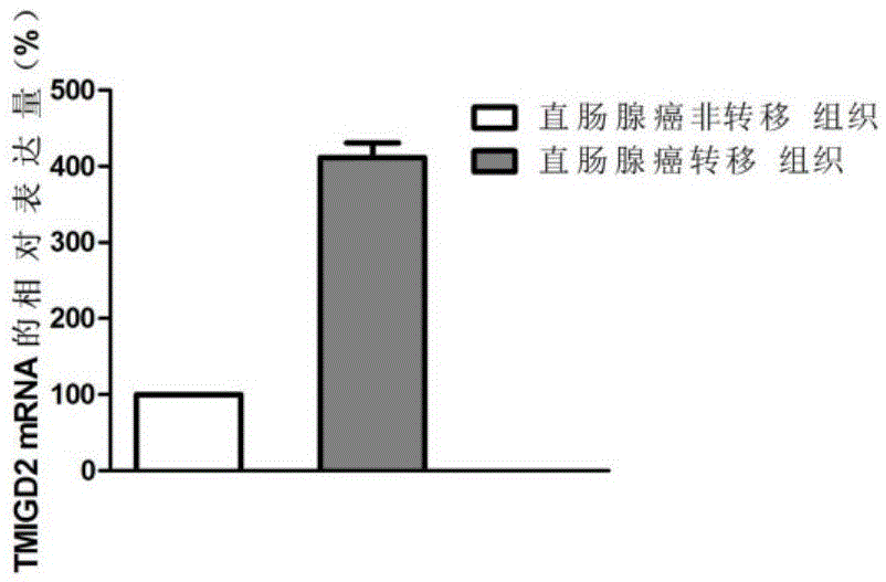 Application of TMIGD2 gene in diagnosing and treating rectal adenocarcinoma