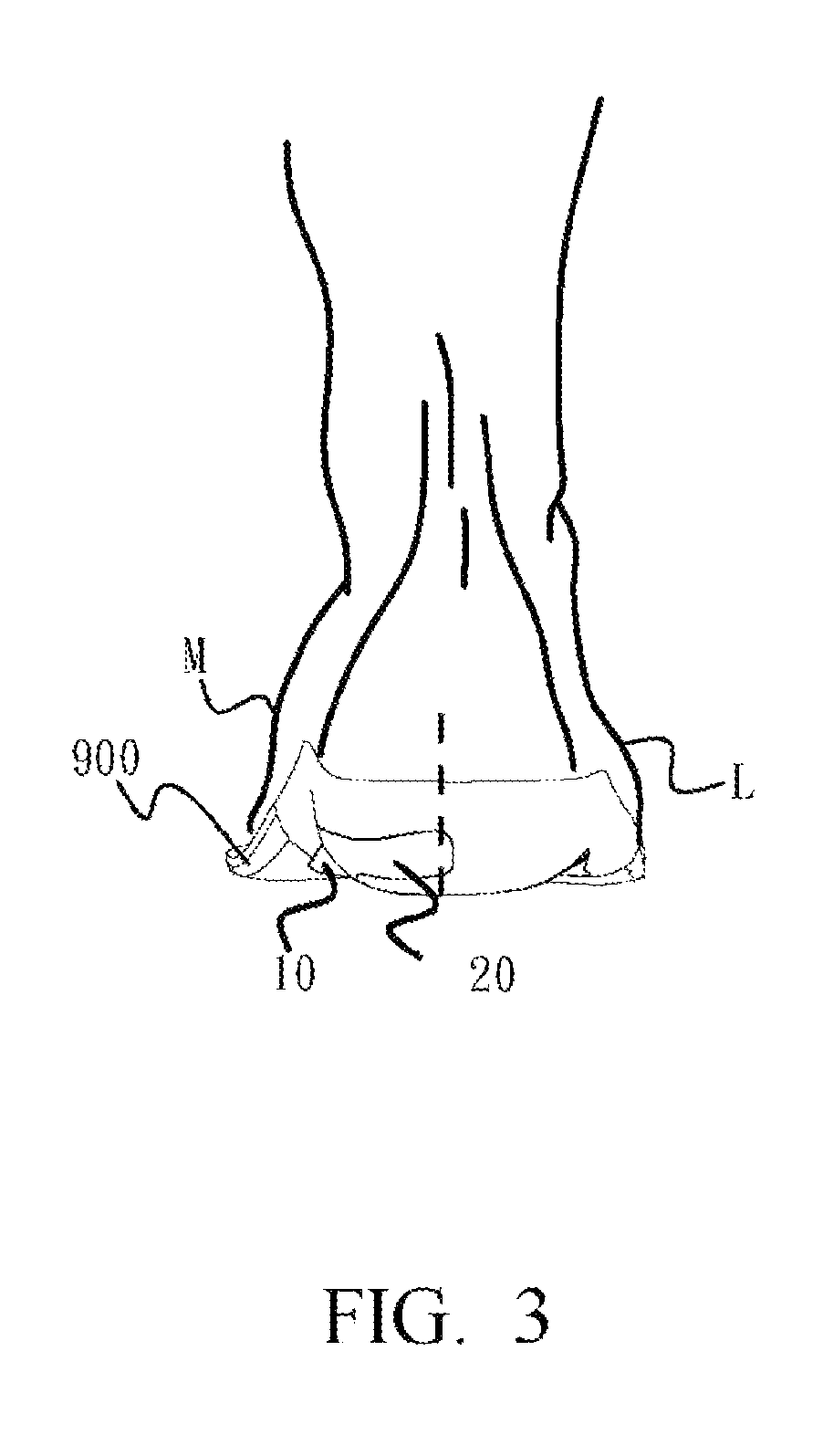Device for three-dimensional foot motion control and plantar pressure redistribution