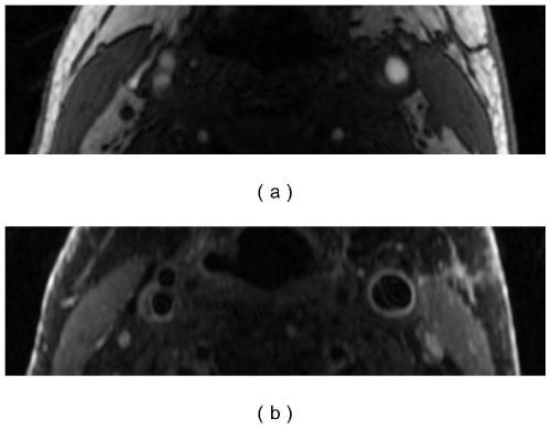 A Multimodal Carotid MRI Registration Method Based on Physical Alignment and Contour Matching