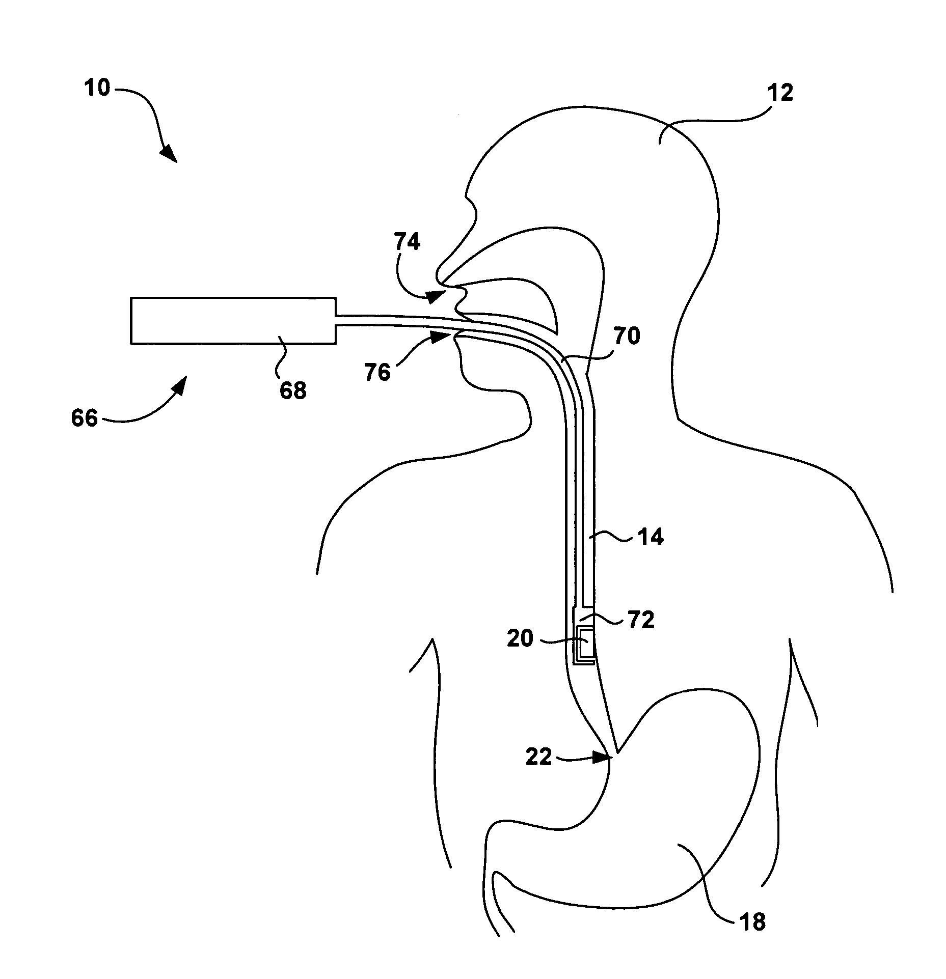 Controlled detachment of intra-luminal medical device