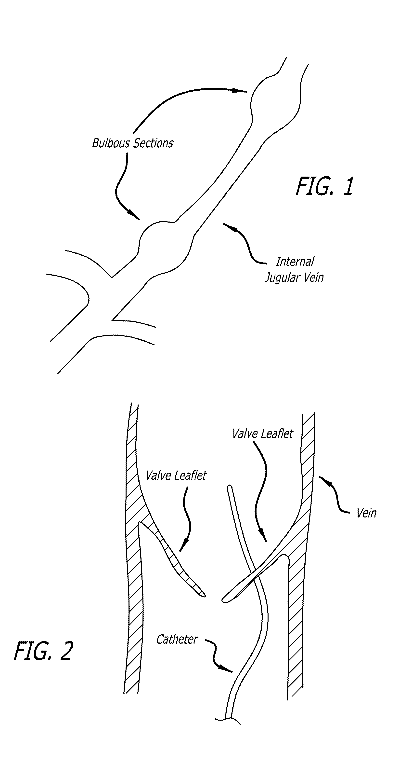 Method of delivering a medical device across a plurality of valves