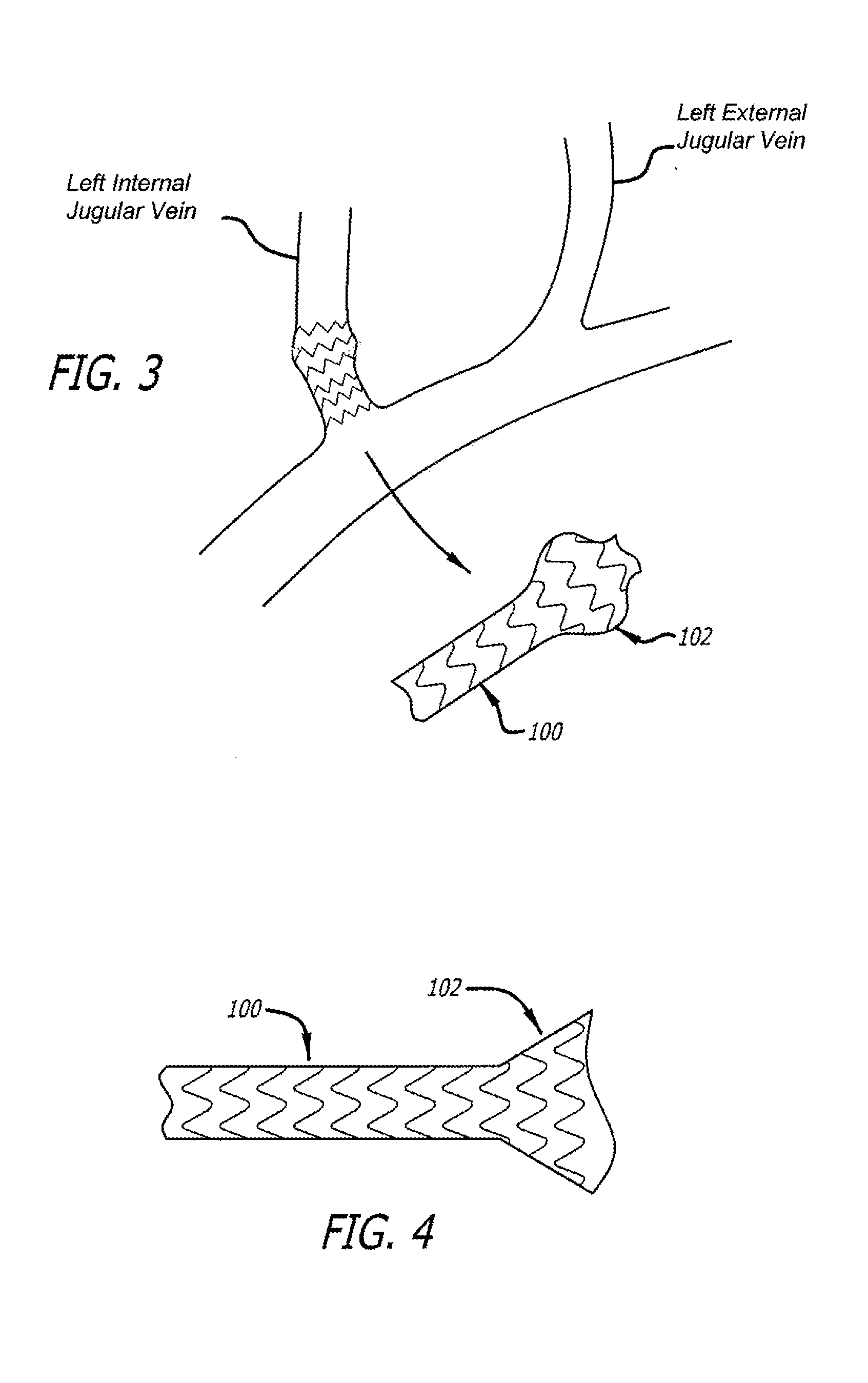 Method of delivering a medical device across a plurality of valves