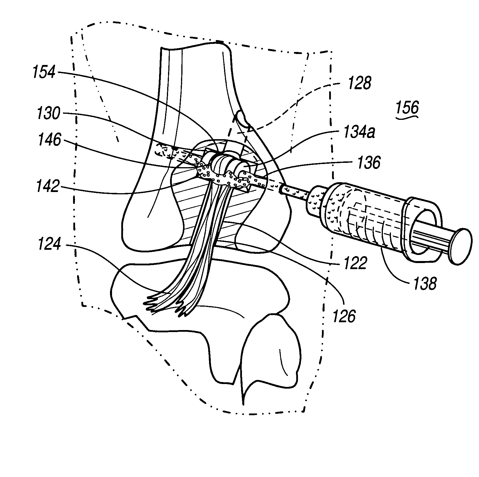Method and apparatus for graft fixation
