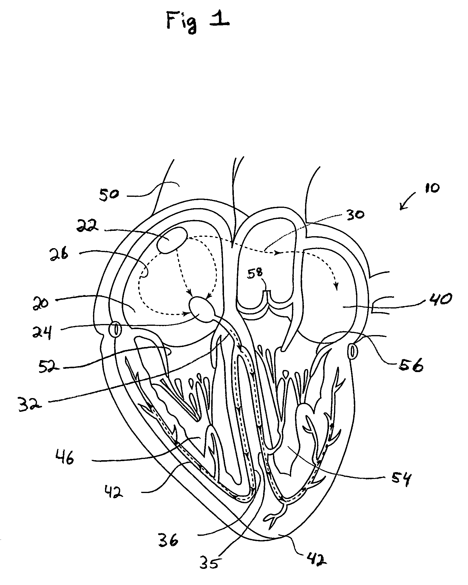 System and method of AV interval selection in an implantable medical device