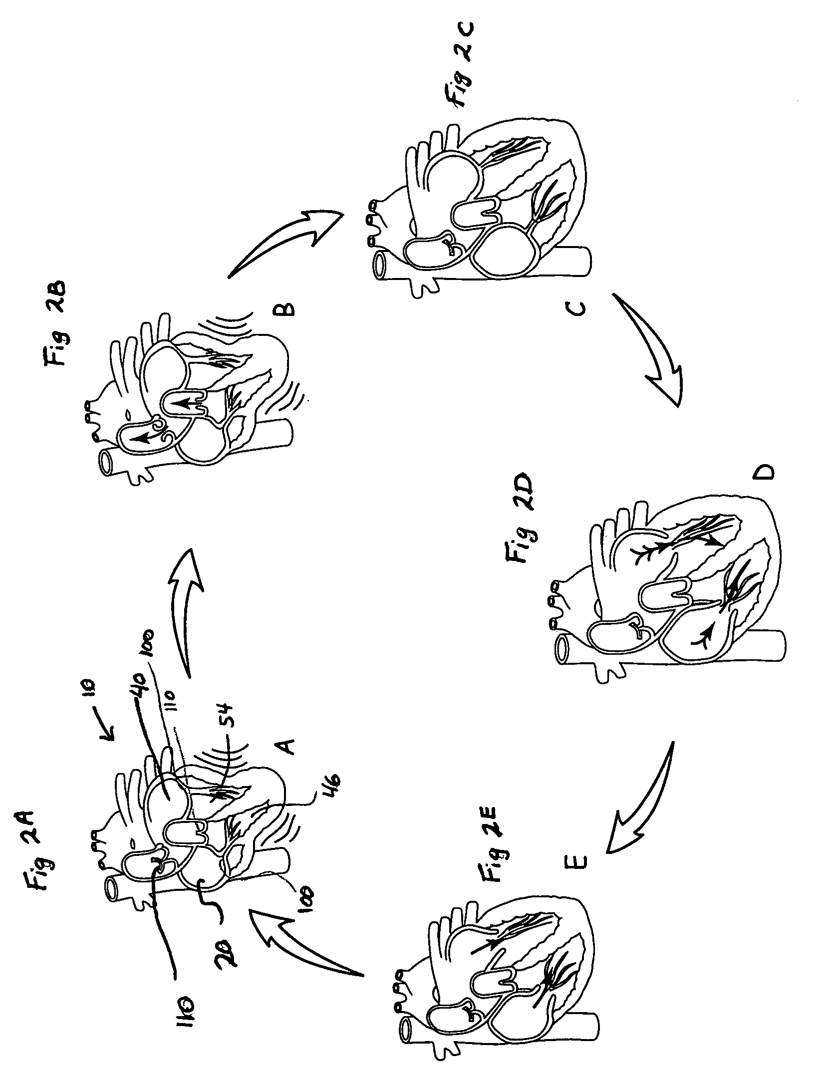 System and method of AV interval selection in an implantable medical device
