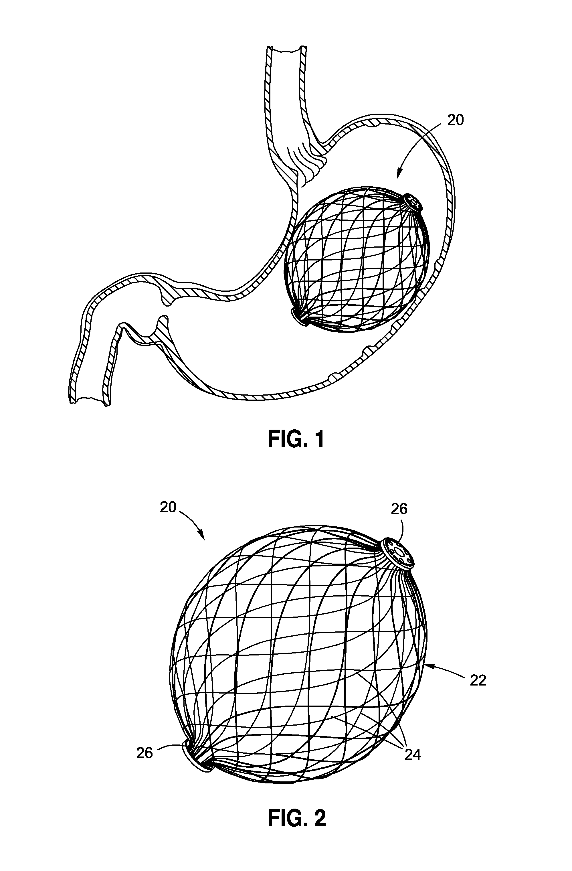 Intragastric implants with collapsible frames