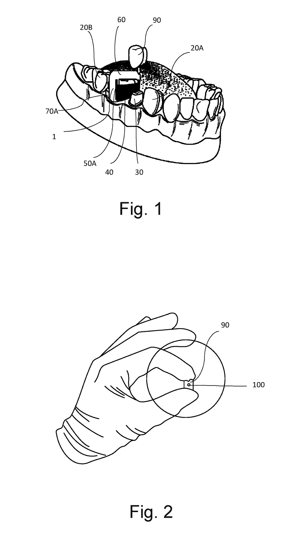 Device for Evaluating Dental Crown Contacts