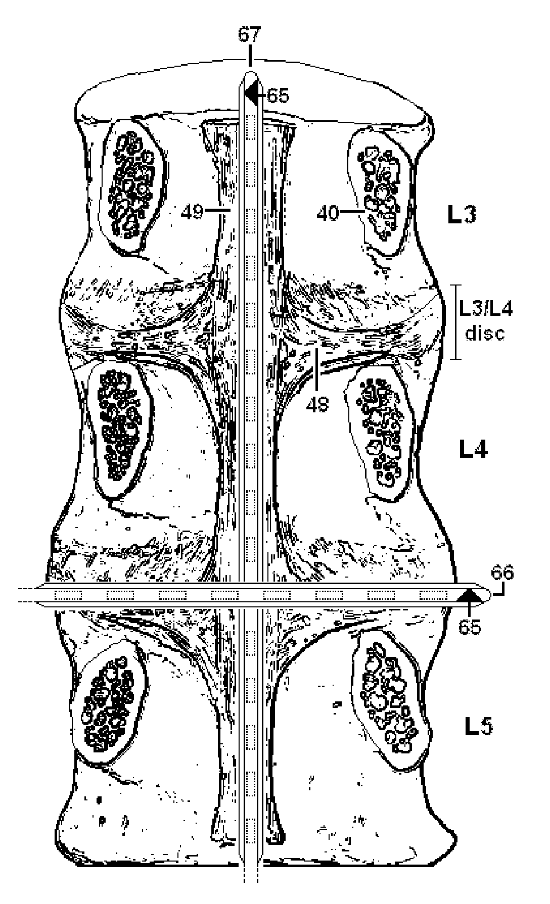 System and Methods for Diagnosis and Treatment of Discogenic Lower Back Pain