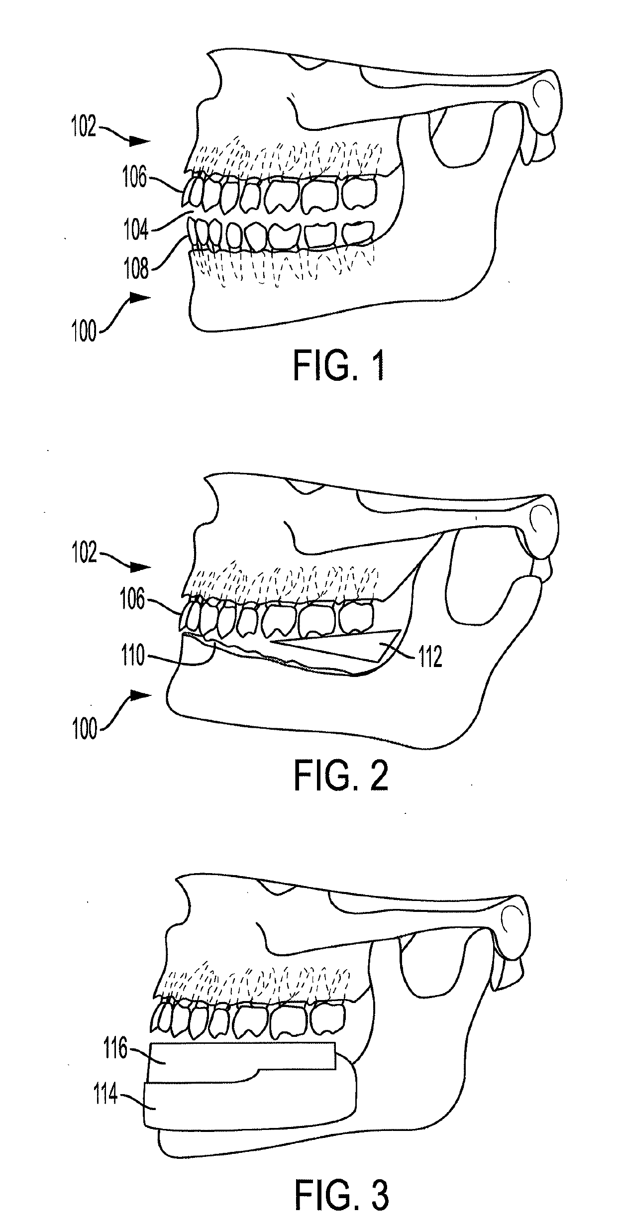 Edentulous specific support and aesthetic restorative appliance