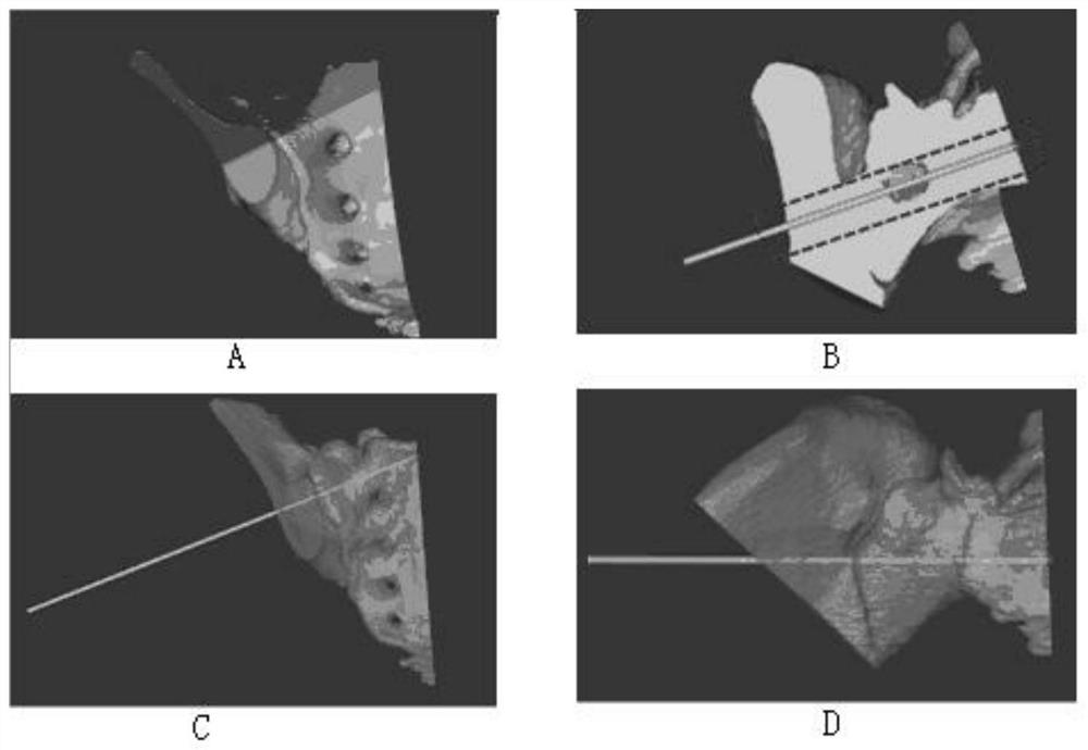 A 3D-printed digital placement method for sacroiliac screws