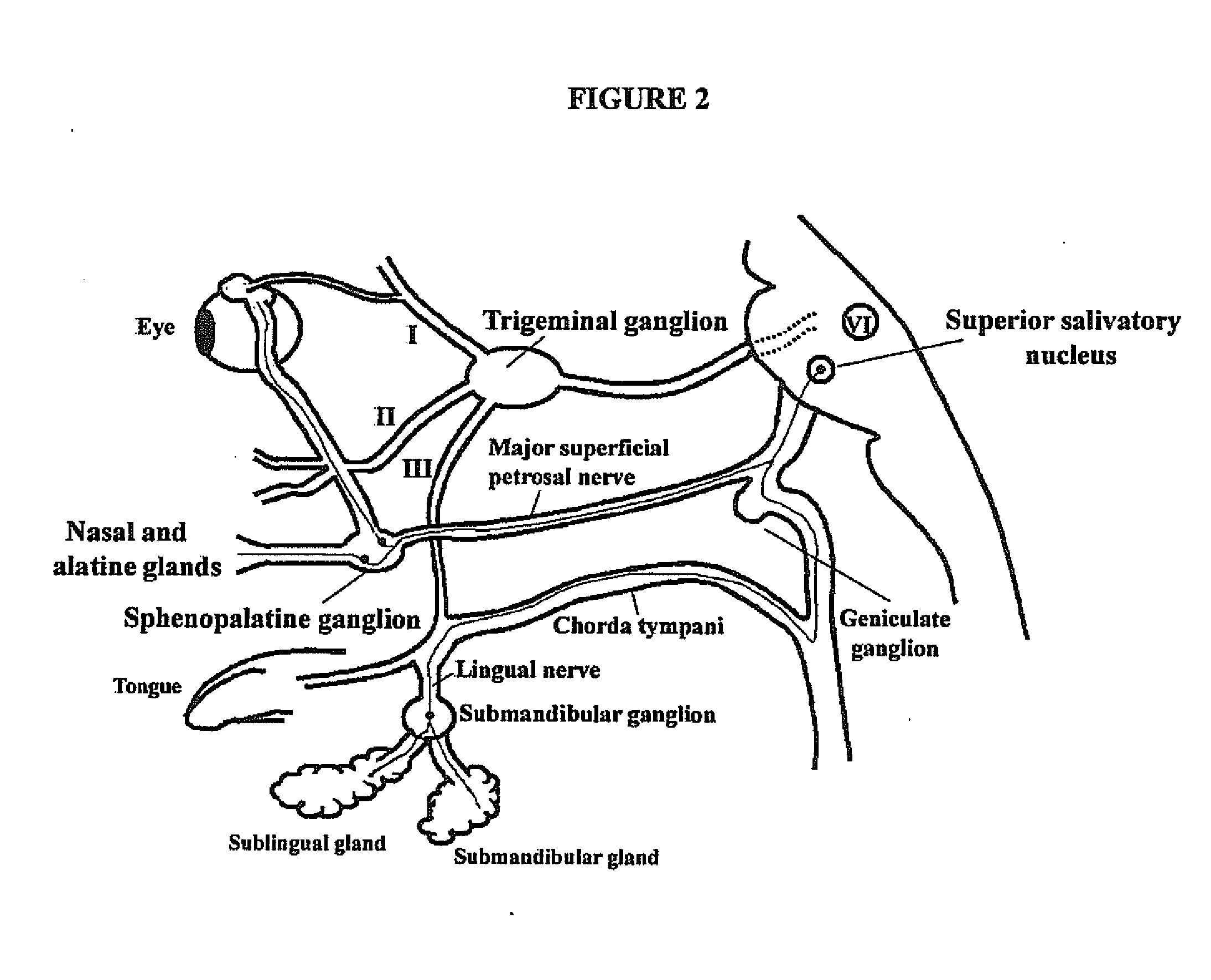 Targeted delivery of botulinum toxin to the sphenopalatine ganglion