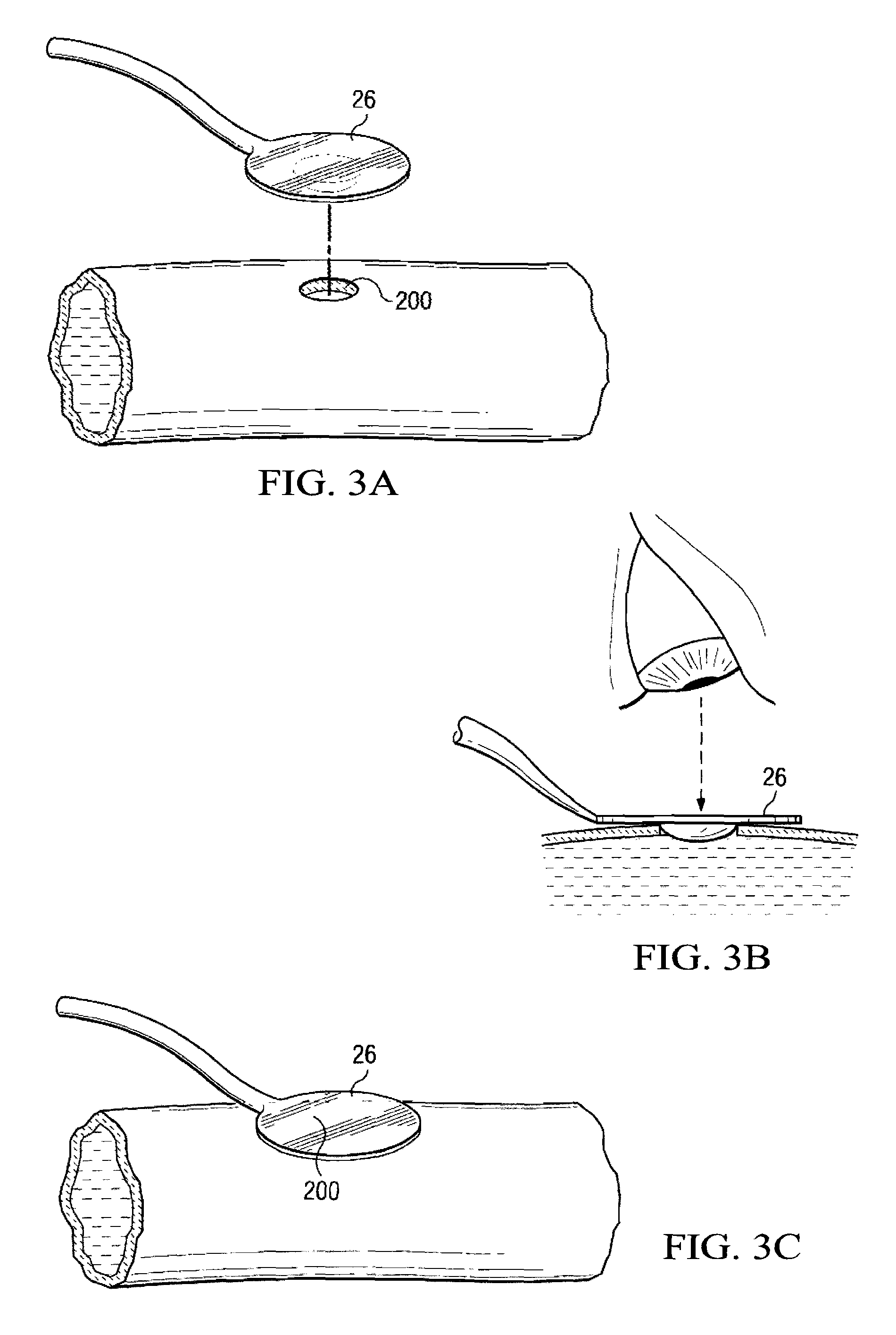System and Method for Providing a Coil Element in a Vascular Environment