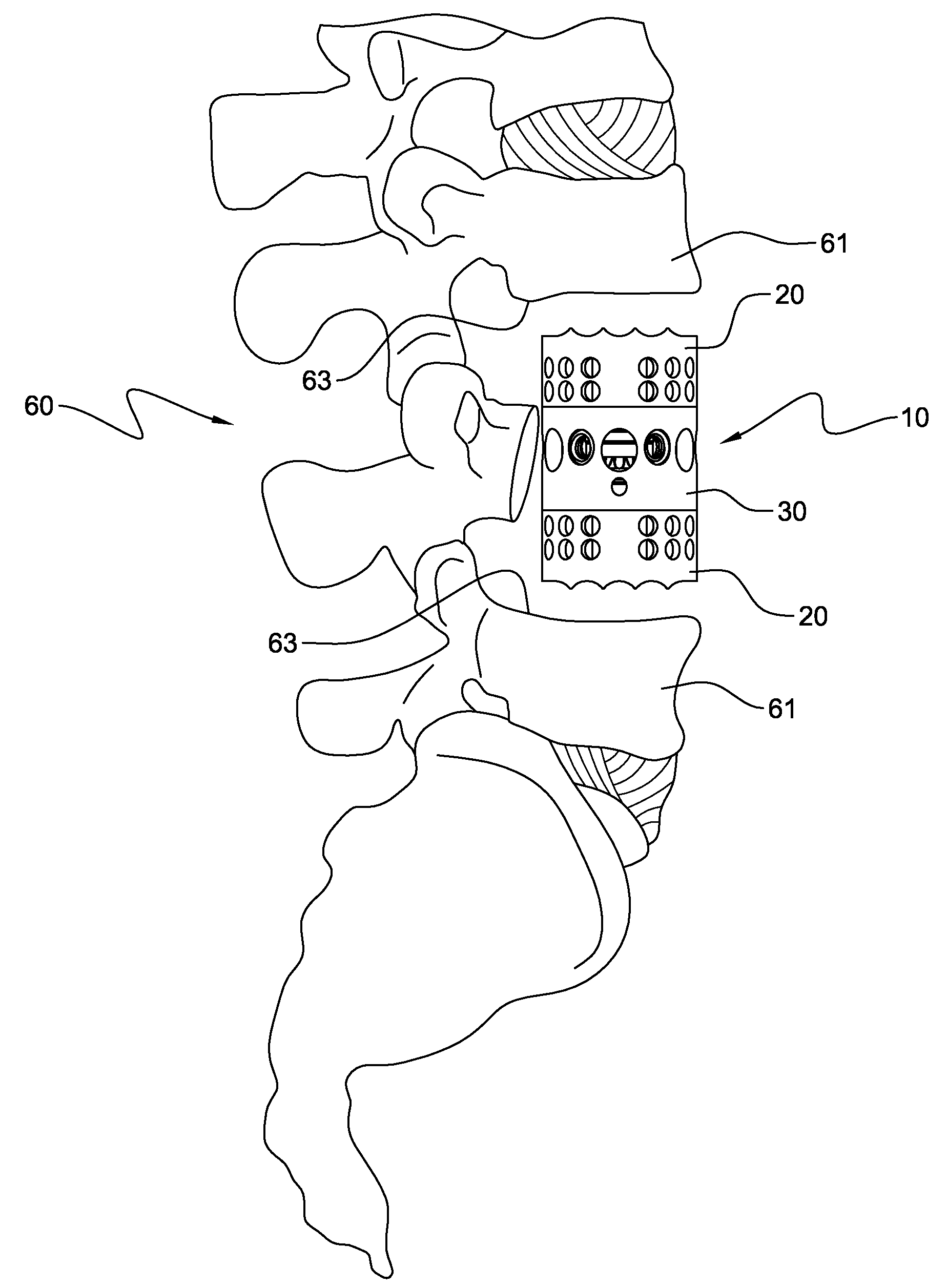 Vertebral body replacement device and method for use to maintain a space between two vertebral bodies within a spine