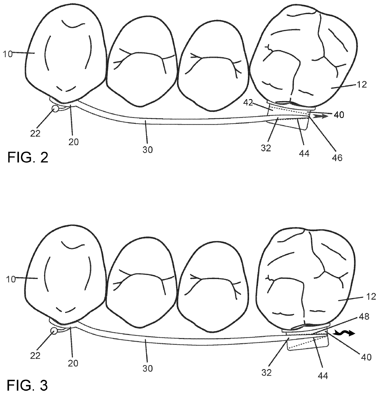 Orthodontic bracket with sliding molar distalizer