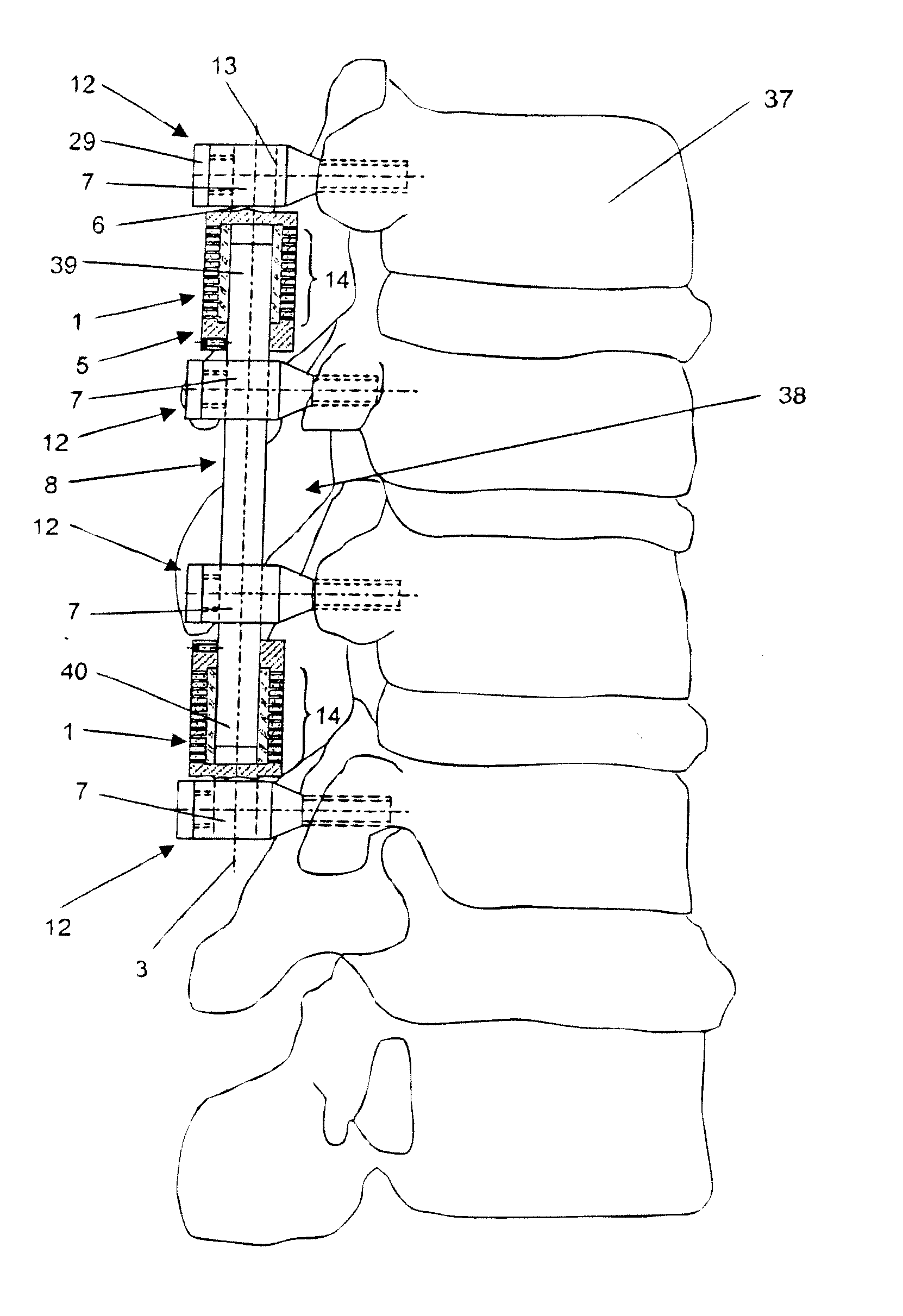 Damping element and device for stabilization of adjacent vertebral bodies