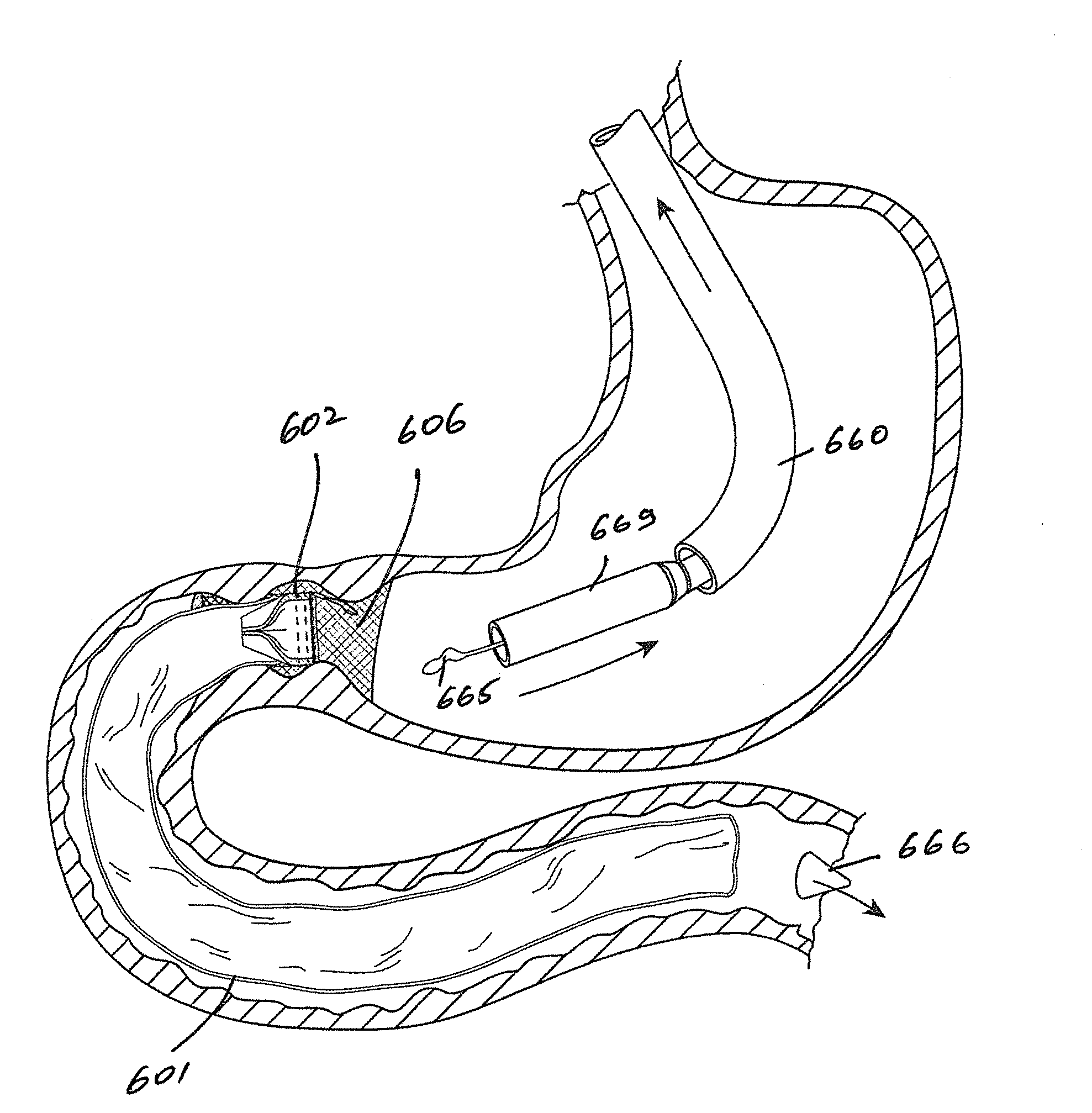 Gastrointestinal implant device and delivery system therefor