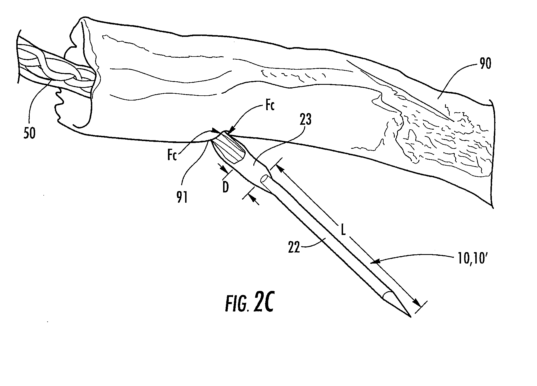 Methods of using compressible tubes for placing implants