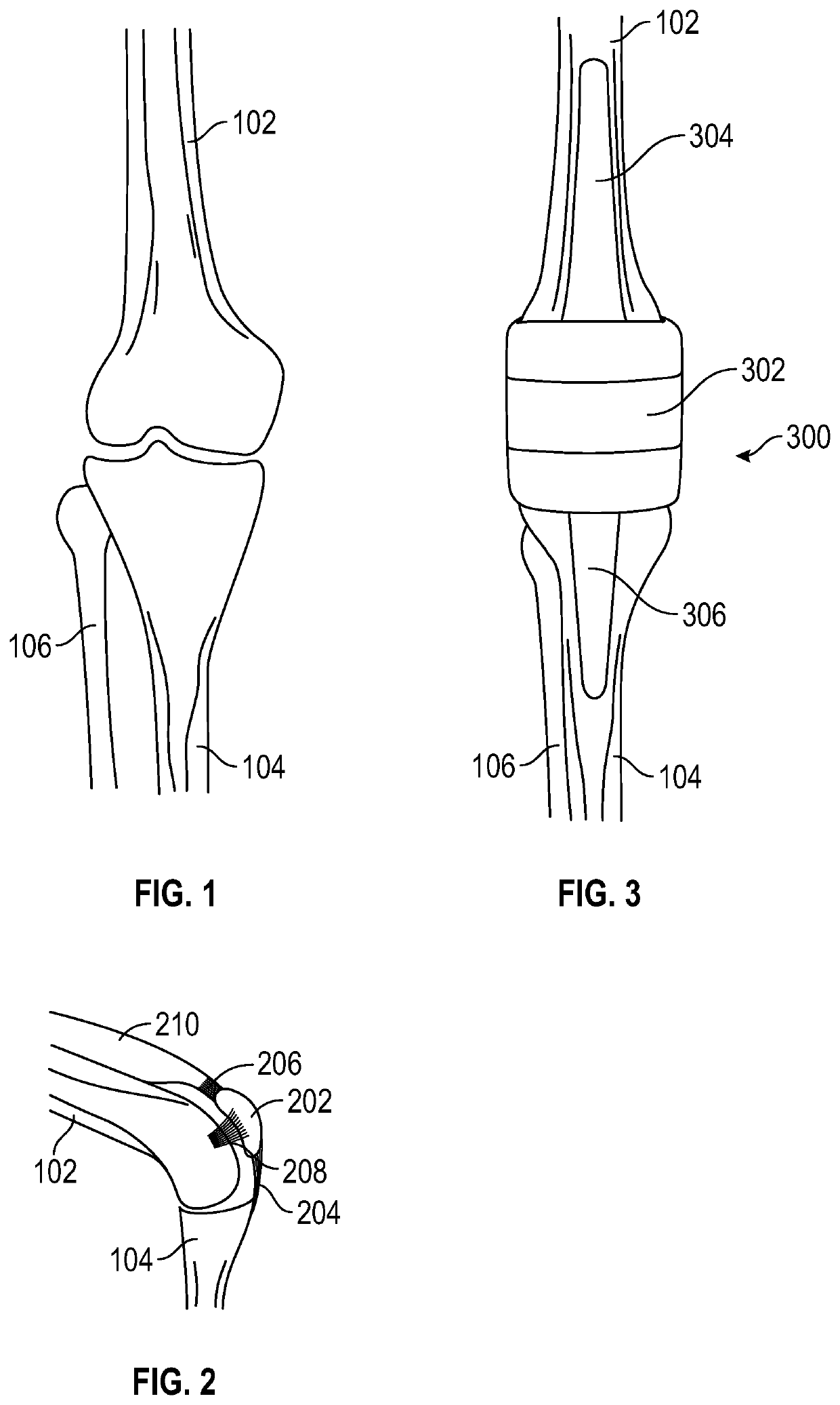 Implantable Knee Prosthesis with Integrated Prosthetic Extensor Mechanism.