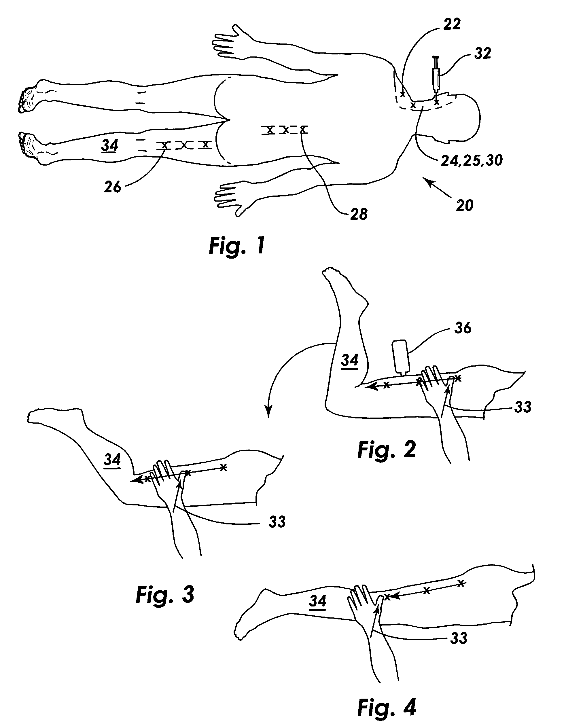 Method of normalizing soft tissue