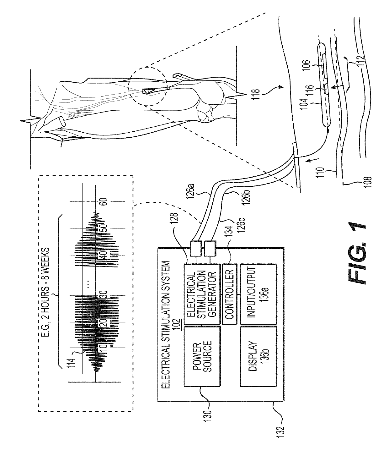 System and method to percutaneously block painful sensations