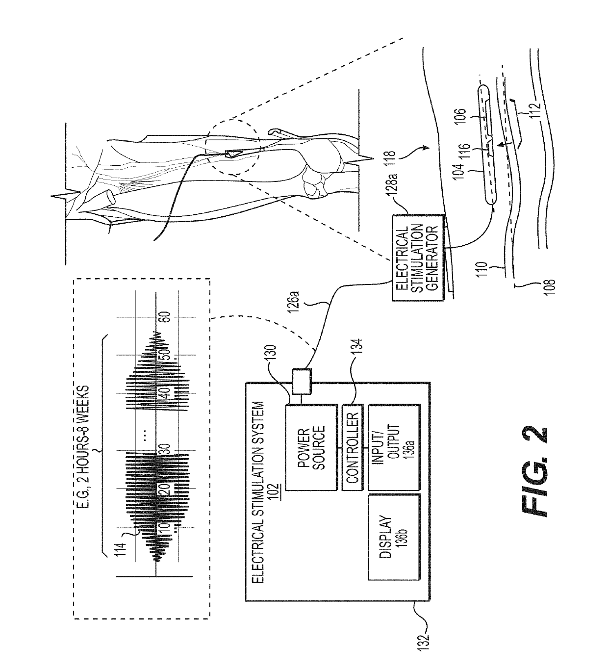 System and method to percutaneously block painful sensations