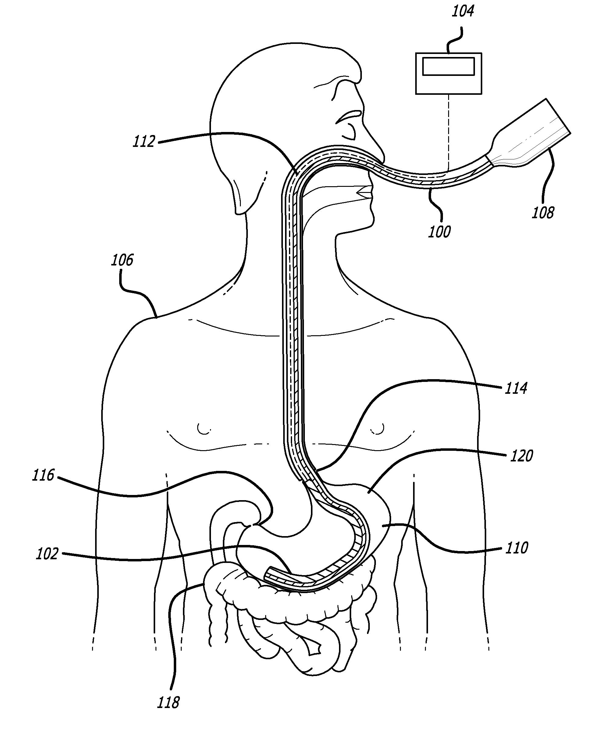 Ng tube with gastric volume detection