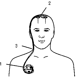 Deep brain stimulation electrode, device and method