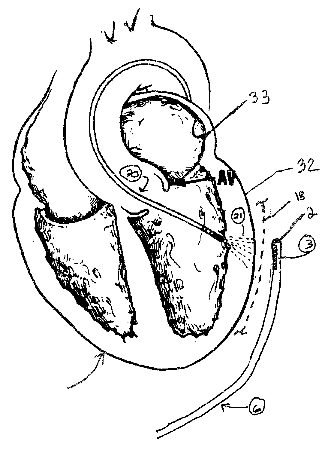 Electrode catheter for ablation purposes and related method thereof