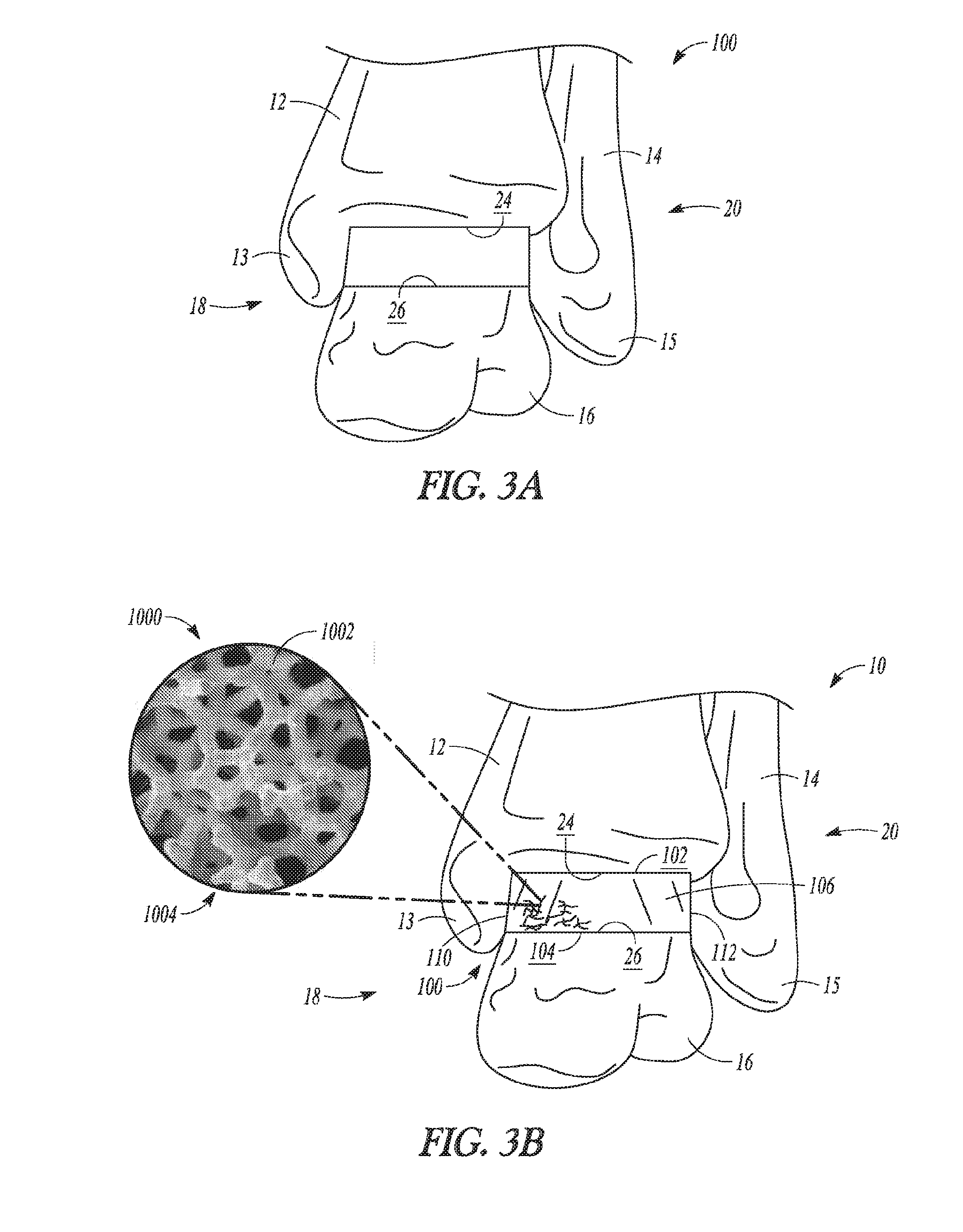 Porous spacers, instruments, and methods for foot and ankle fusion