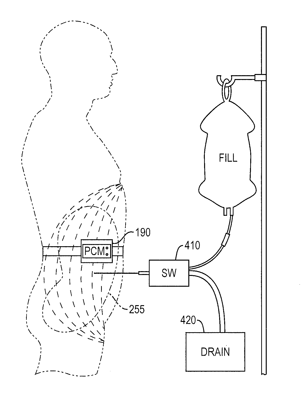 System and method of monitoring and control of ultrafiltration volume during peritoneal dialysis using segmental bioimpedance