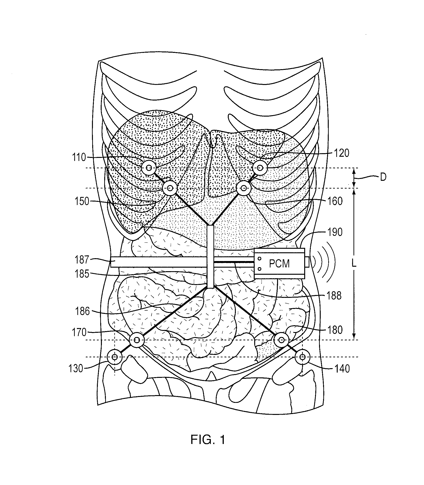 System and method of monitoring and control of ultrafiltration volume during peritoneal dialysis using segmental bioimpedance