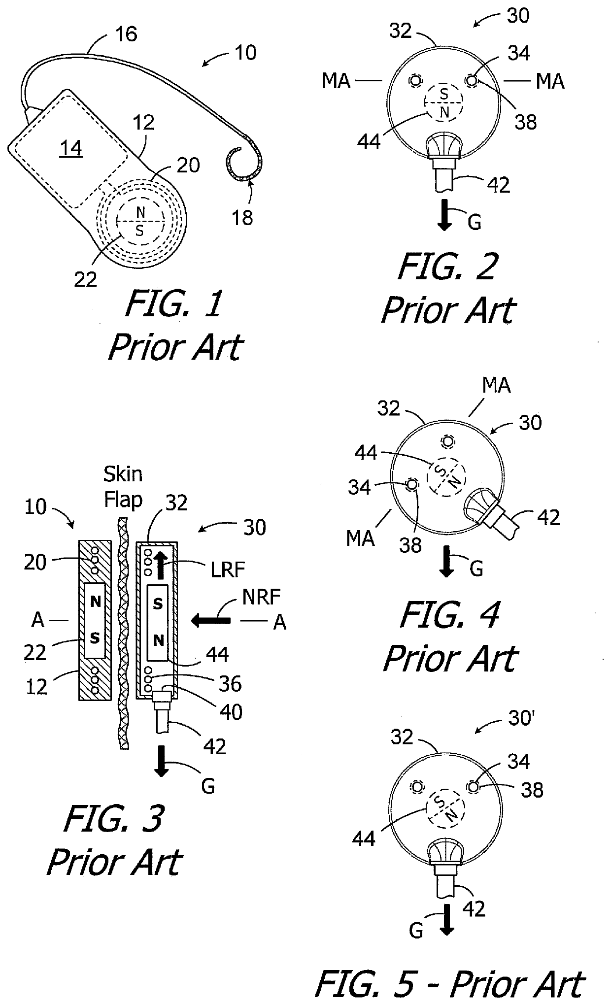 Headpieces and implantable cochlear stimulation systems including the same