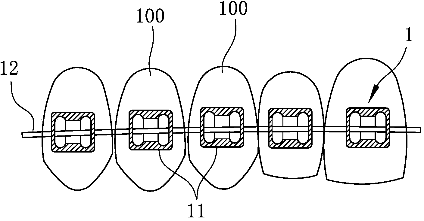 Orthodontic system and manufacturing method thereof