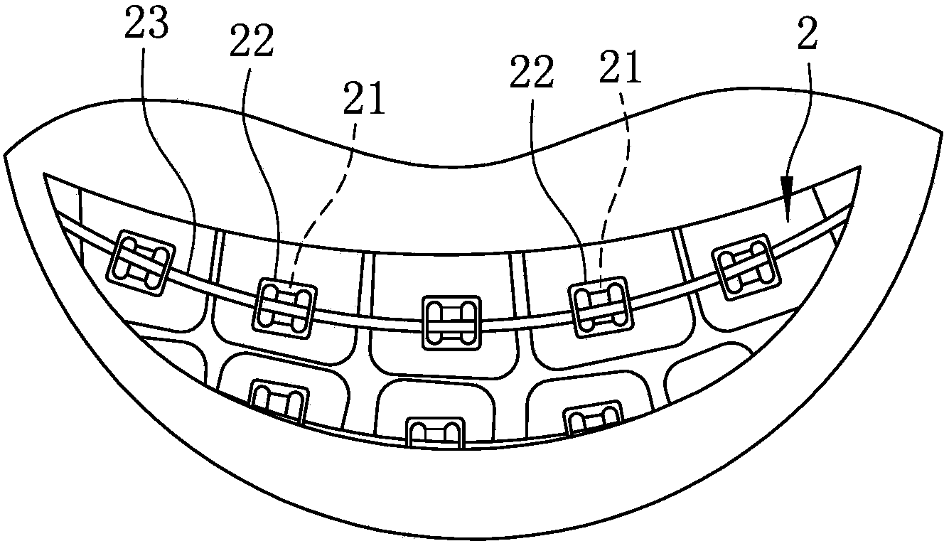 Orthodontic system and manufacturing method thereof