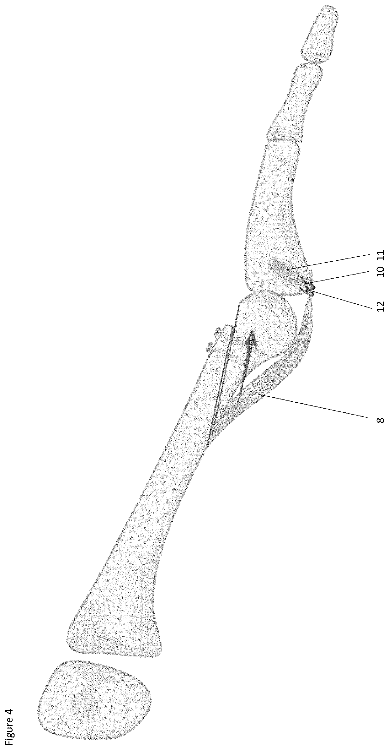 Novel surgical methods for the treatment of plantar plate injury