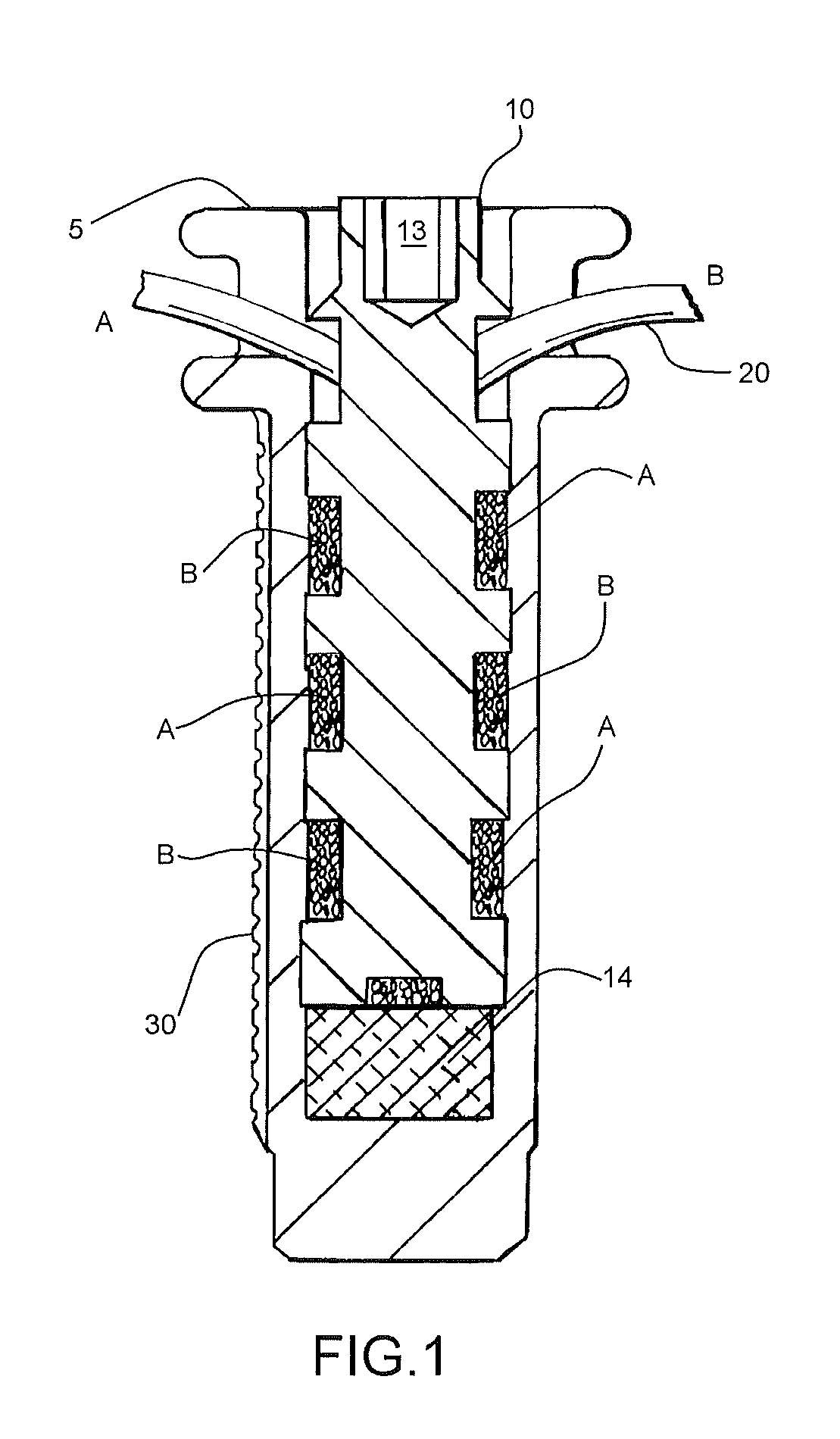 Internal joint bracing system and suture anchoring assembly therefore