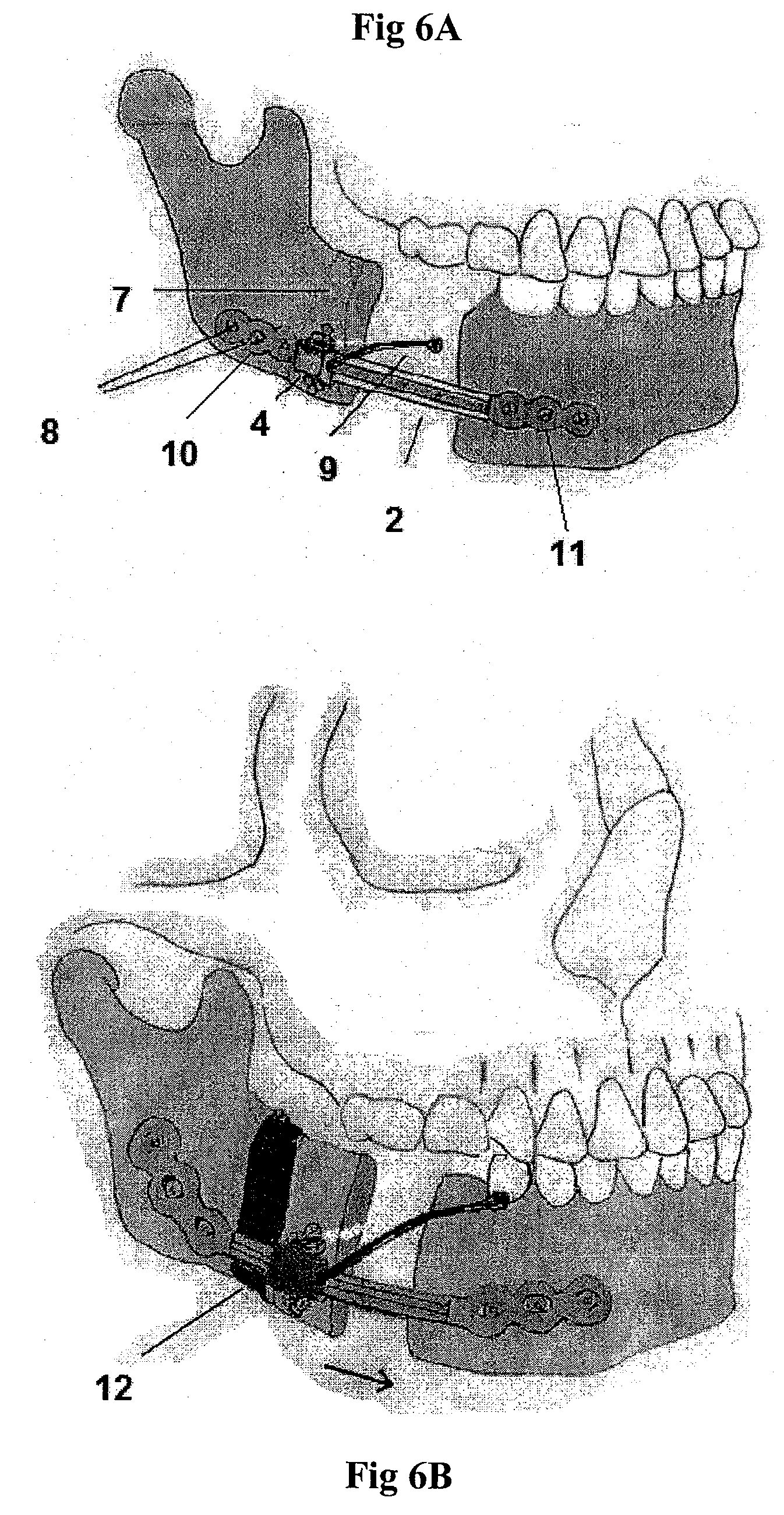 Mandibular Bone Transport Reconstruction Plate