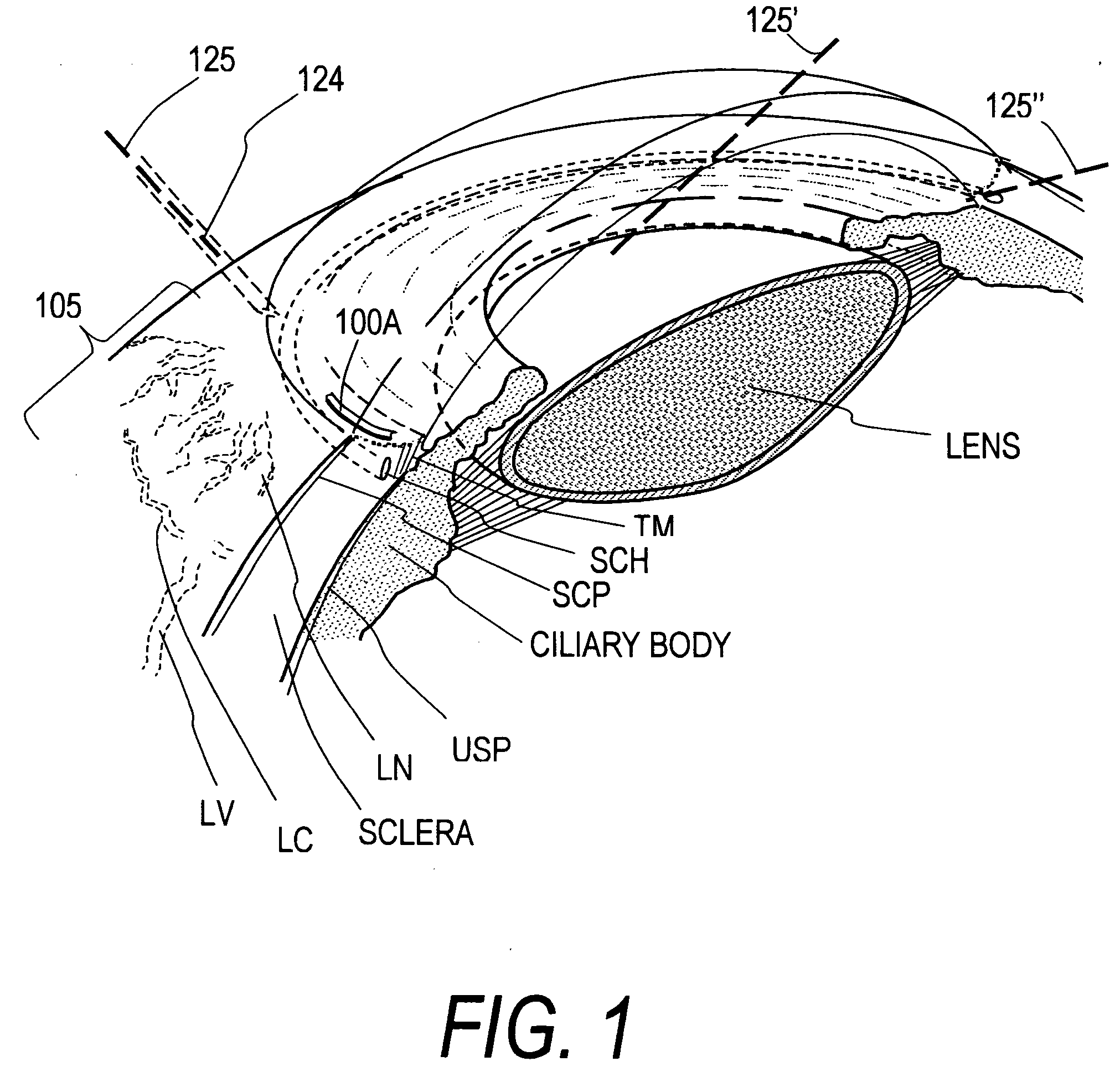 Implants for treating ocular hypertension, methods of use and methods of fabrication